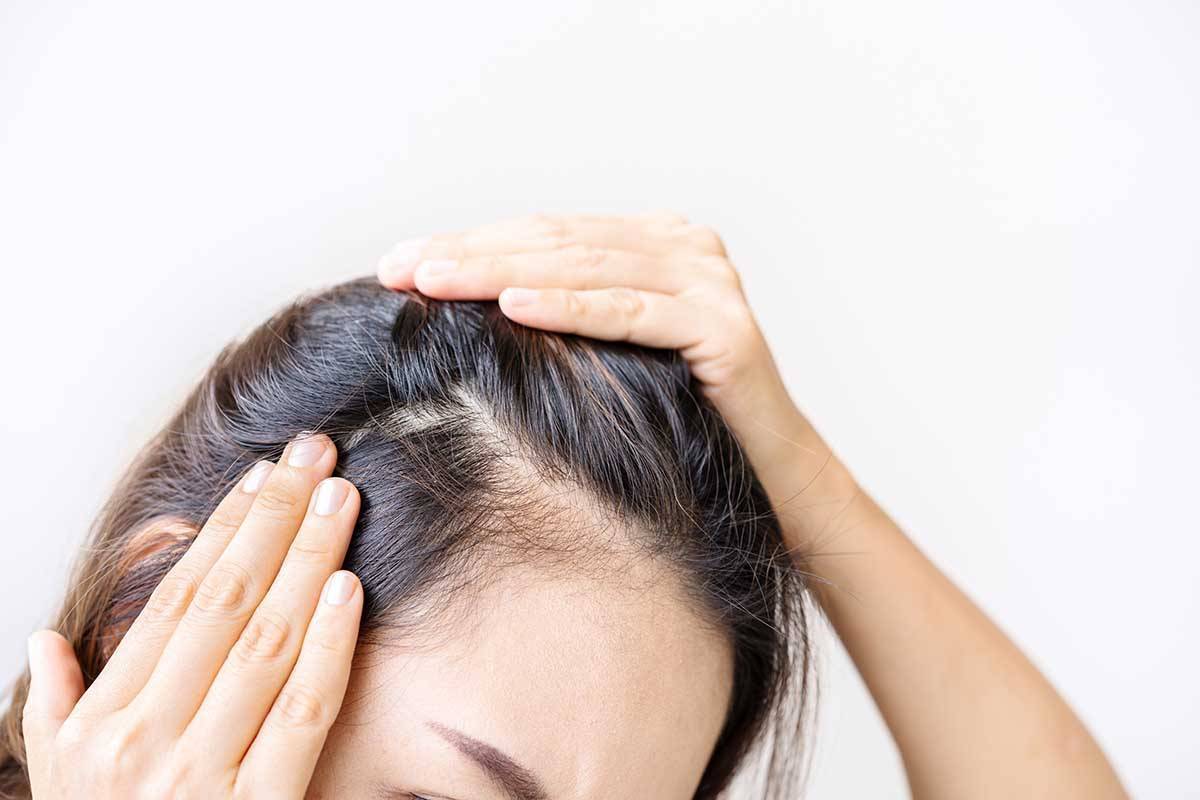 Alopezie – Haarausfall